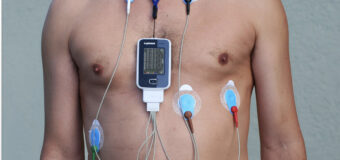 Holter ECG: cosa significa e a cosa serve